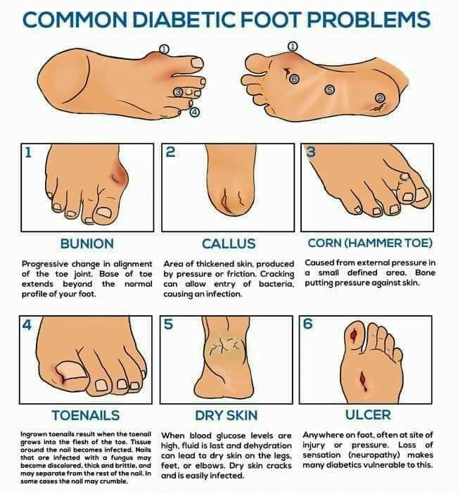 Chart of diabetic feet problem 